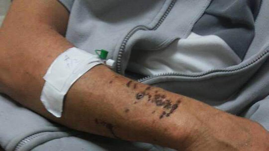 Yawar Nasser Yawar con tiro que le atraveso palma mano izquierda/ Imagen cedia por la familia