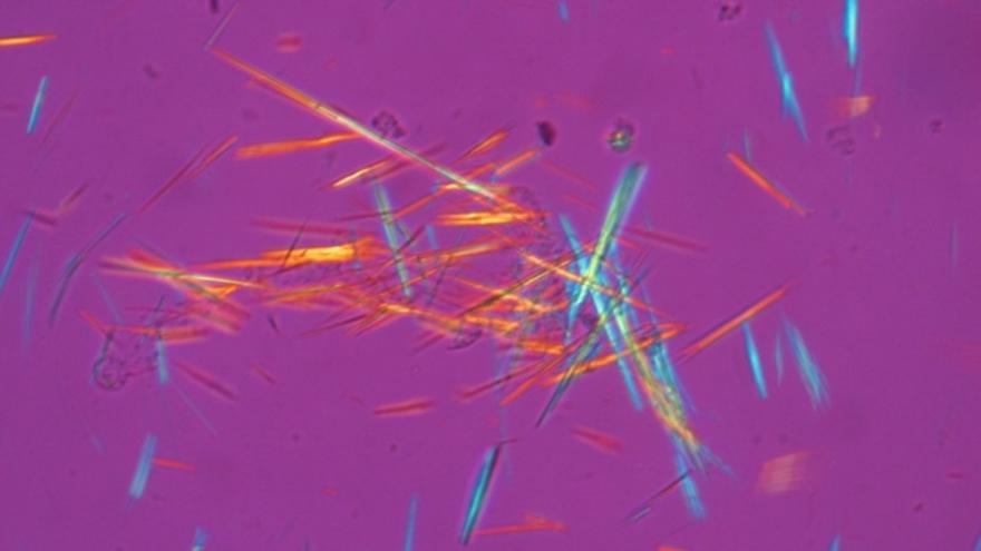 Cristales de ureato sódico en el fluido sinovial de una articulación vistos con luz polarizada. Imagen: Bob James Galindo.