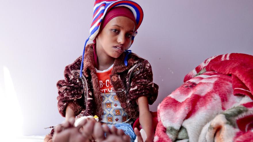 Saida, que está recibiendo tratamiento en el hospital Al-Sabeen de Save the Children en Sana'a, tiene 18 años pero se parece más a una niña de ocho años.