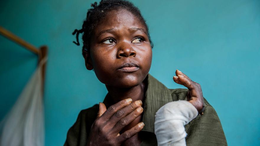 A Ntumba Kasomba (31 años) tienen que amputarle el brazo izquierdo por una antigua herida de machete. A ella y a su familia les atacaron los milicianos en su pueblo natal, Senge. Vio cómo niños pequeños recibían cortes de machete. Ha visto morir a cinco de sus hijos y su esposo recibió un disparo. Solo entre 50 y 100 personas de su pueblo han sobrevivido a la violencia. © Marta Sosynska / MSF